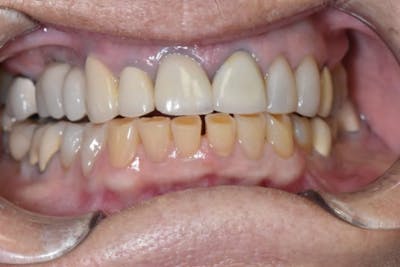 Smile Makeover Before & After Gallery - Patient 39578480 - Image 1