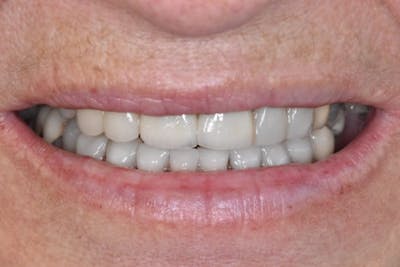Smile Makeover Before & After Gallery - Patient 39578480 - Image 2