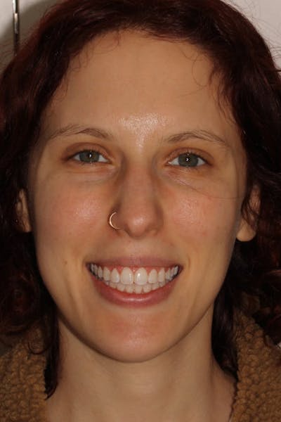 Laser Gum Contouring Before & After Gallery - Patient 39578489 - Image 2