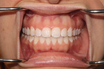 Laser Gum Contouring Before & After Gallery - Patient 39578489 - Image 3