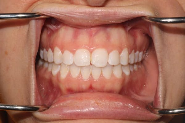 Laser Gum Contouring Before & After Gallery - Patient 39578489 - Image 3