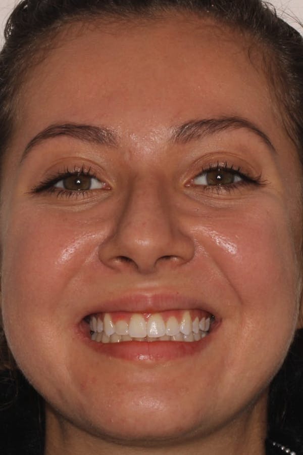 Laser Gum Contouring Before & After Gallery - Patient 39578490 - Image 1
