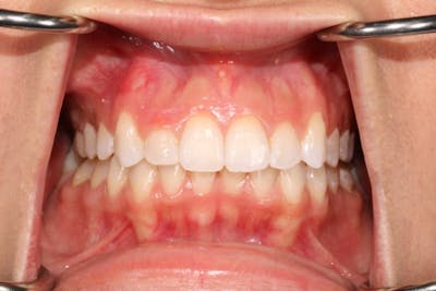 Laser Gum Contouring Before & After Gallery - Patient 39578490 - Image 3