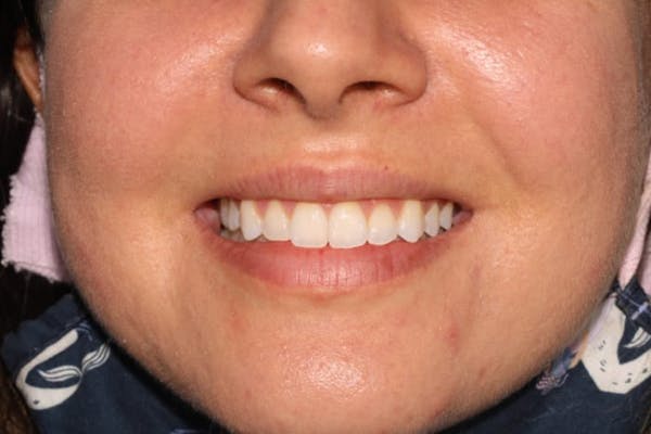Laser Gum Contouring Before & After Gallery - Patient 39578490 - Image 4