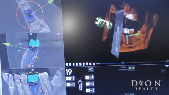 Navigation Live Guided Implant Surgery