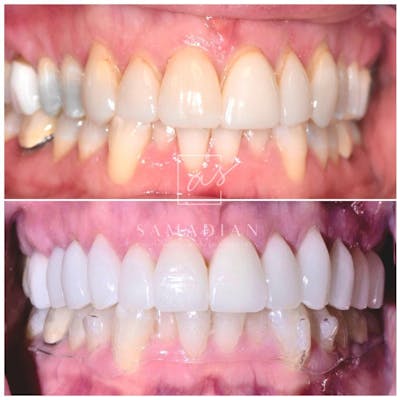 Veneers Before & After Gallery - Patient 53271815 - Image 1