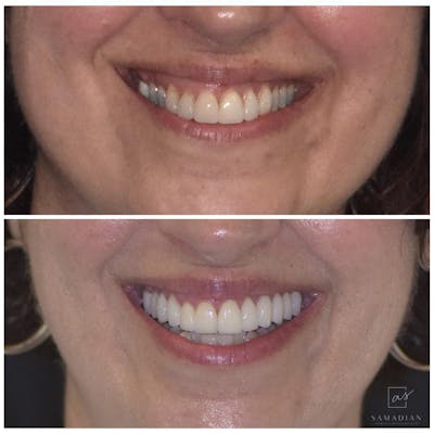 Veneers Before & After Gallery - Patient 56175436 - Image 1