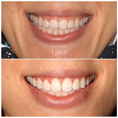 Laser Gum Contouring Before & After Gallery - Patient 53271886 - Image 1