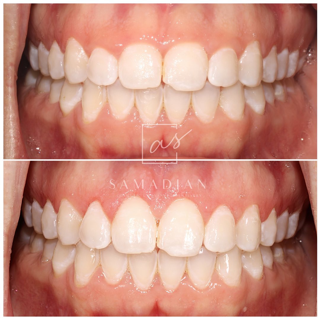 Laser Gum Contouring Before & After Photos
