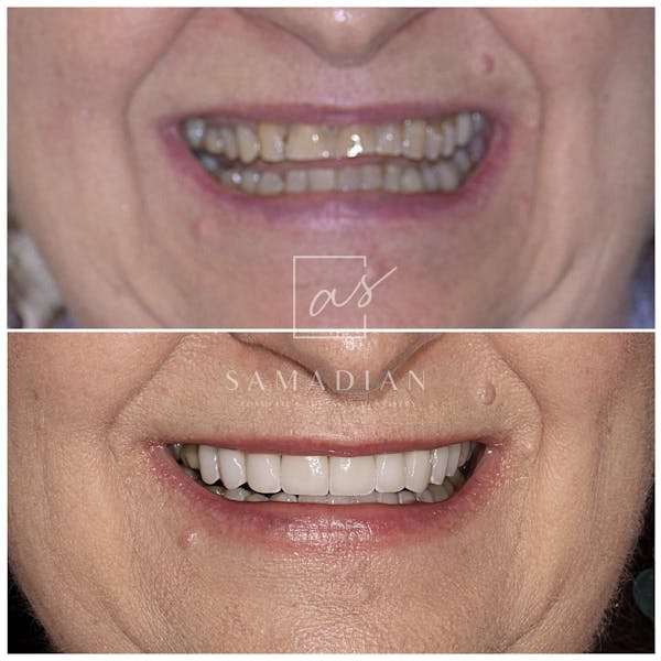 Smile Makeover Before & After Gallery - Patient 53271901 - Image 1