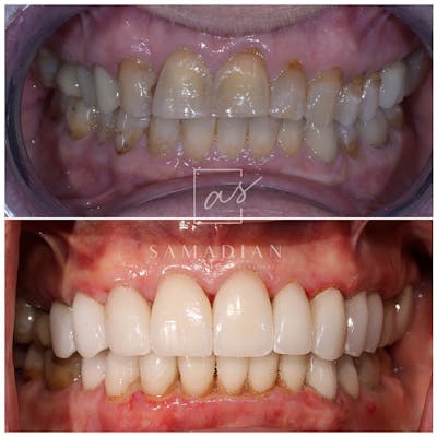 Smile Makeover Before & After Gallery - Patient 53271901 - Image 2