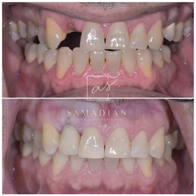 Dental Implants Before & After Gallery - Patient 39578182 - Image 2