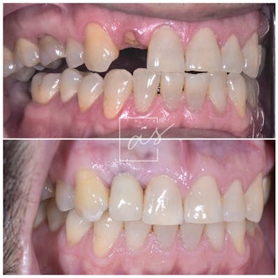 Dental Implants Before & After Gallery - Patient 39578182 - Image 3