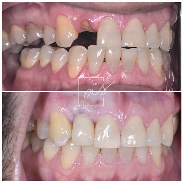 Dental Implants Before & After Gallery - Patient 39578182 - Image 3