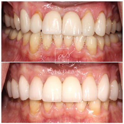 Veneers Before & After Gallery - Patient 56175435 - Image 2