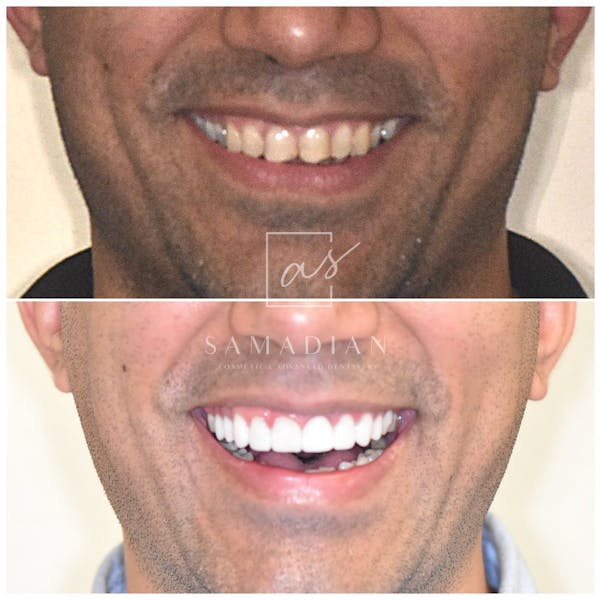 Veneers Before & After Gallery - Patient 53271996 - Image 1