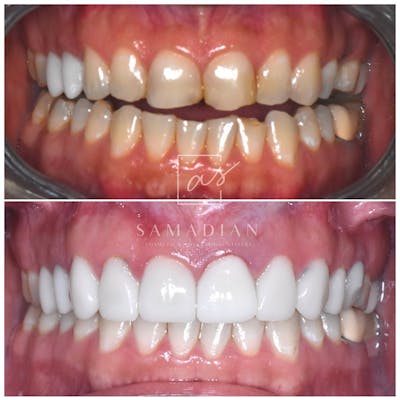 Smile Makeover Before & After Gallery - Patient 39578143 - Image 2