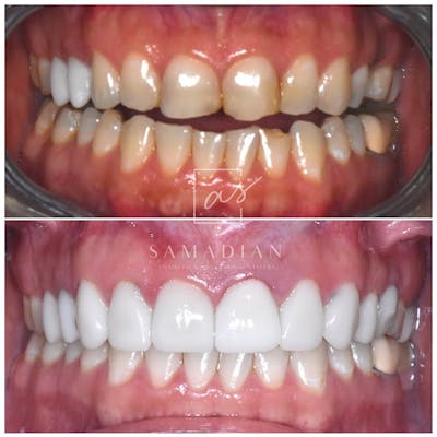 Veneers Before & After Gallery - Patient 53271996 - Image 2