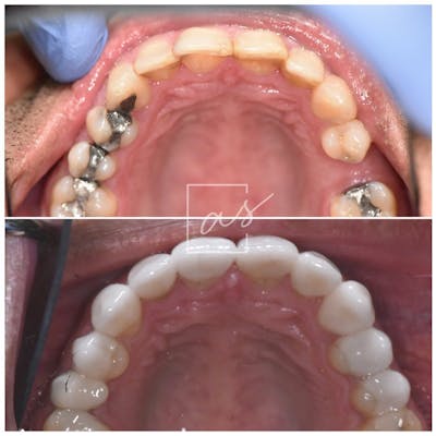 Veneers Before & After Gallery - Patient 53271996 - Image 3