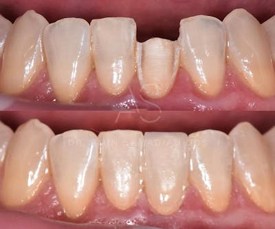 Veneers Before & After Gallery - Patient 56175438 - Image 1