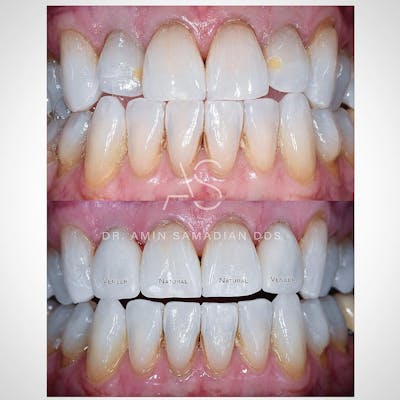 Veneers Before & After Gallery - Patient 56175439 - Image 1