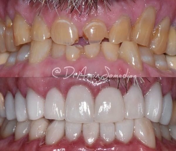 Smile Makeover Before & After Gallery - Patient 53276934 - Image 1