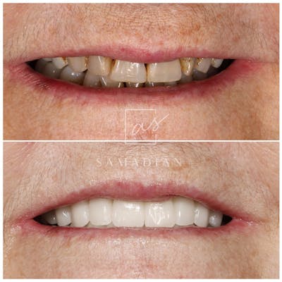 Smile Makeover Gallery - Patient 54674902 - Image 1