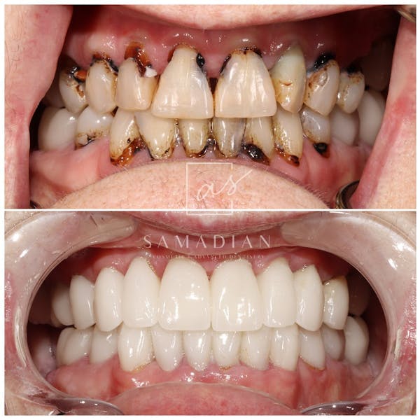 Smile Makeover Gallery - Patient 54674902 - Image 2