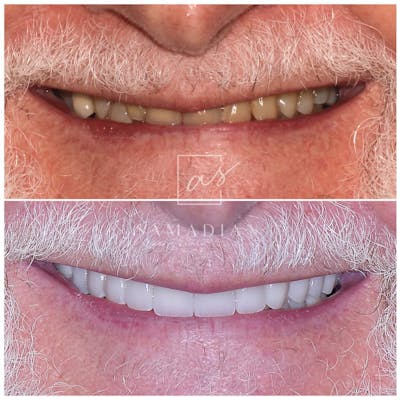 Smile Makeover Gallery - Patient 39578157 - Image 1