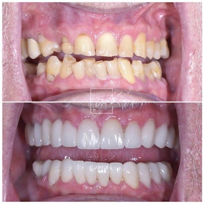 Smile Makeover Gallery - Patient 39578157 - Image 2