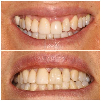 Veneers Before & After Gallery - Patient 56164177 - Image 1