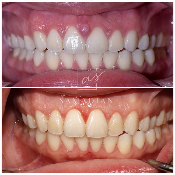 Gum Lift Before & After Gallery - Patient 59681506 - Image 2
