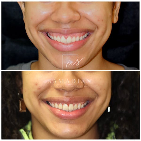 Gum Lift Before & After Gallery - Patient 59681506 - Image 1