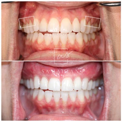 Gum Lift Before & After Gallery - Patient 59681570 - Image 1