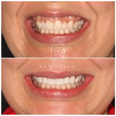 Veneers Before & After Gallery - Patient 97775222 - Image 1