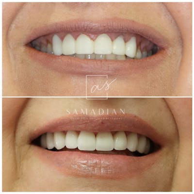 Veneers Before & After Gallery - Patient 119555979 - Image 1