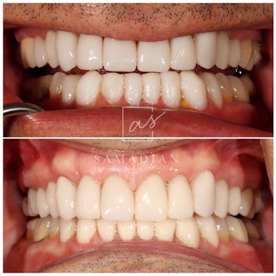 Veneers Before & After Gallery - Patient 119555978 - Image 1