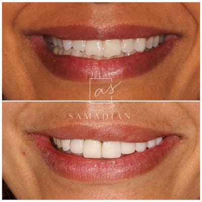 Smile Makeover Before & After Gallery - Patient 119556401 - Image 1