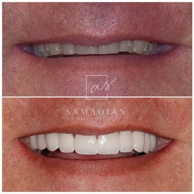 Smile Makeover Before & After Gallery - Patient 119558337 - Image 1