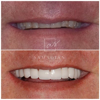 Smile Makeover Before & After Gallery - Patient 119558337 - Image 1