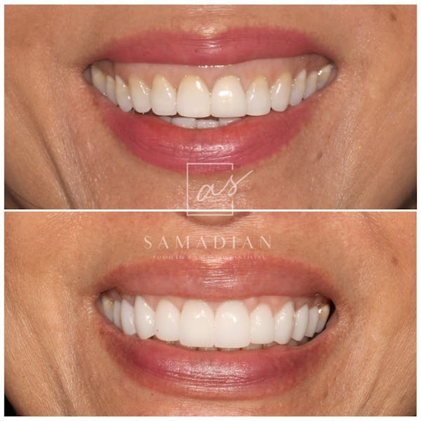 Smile Makeover Gallery - Patient 119558804 - Image 1