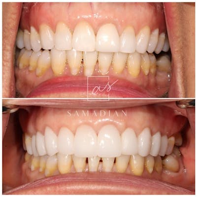 Smile Makeover Before & After Gallery - Patient 119558804 - Image 2