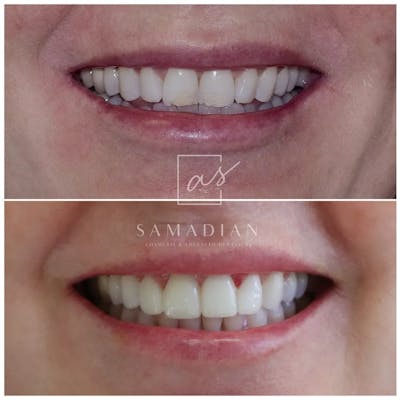 Veneers Before & After Gallery - Patient 121543529 - Image 1