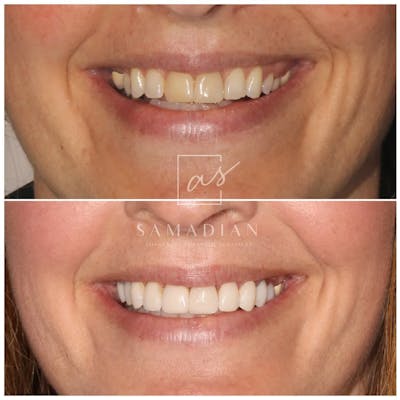 Veneers Before & After Gallery - Patient 121543604 - Image 1