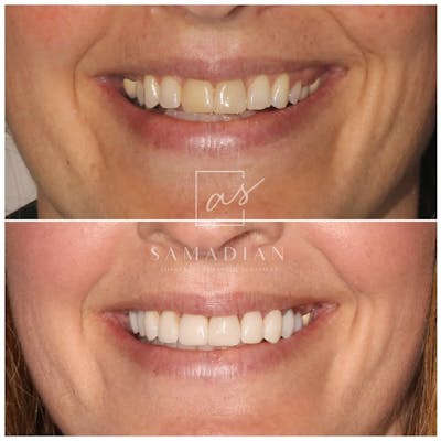 Smile Makeover Gallery - Patient 121543603 - Image 1