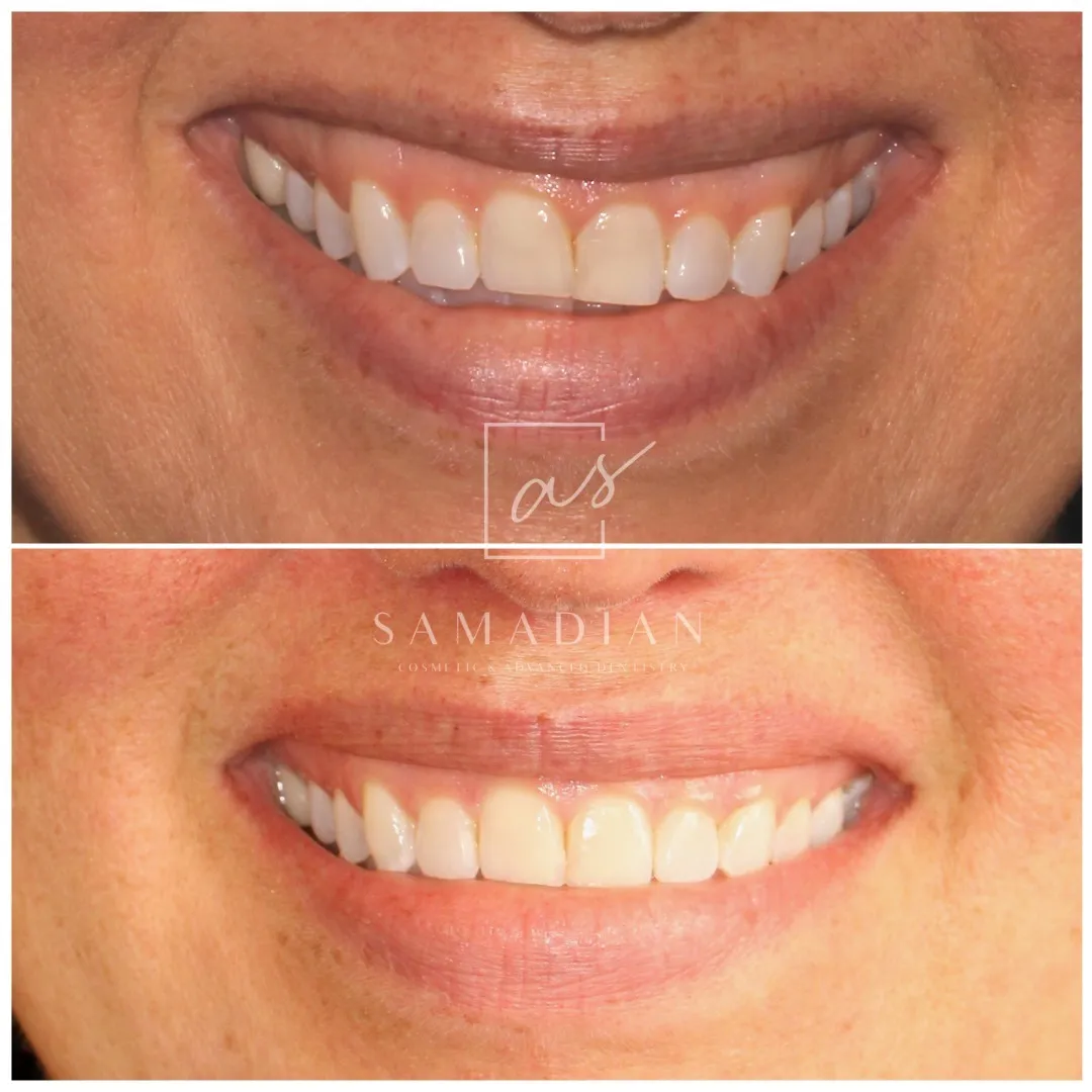 Expert Gum Contouring Services in Texas