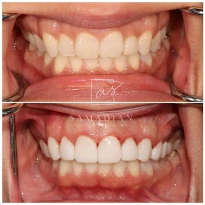 Veneers Before & After Gallery - Patient 121543659 - Image 1