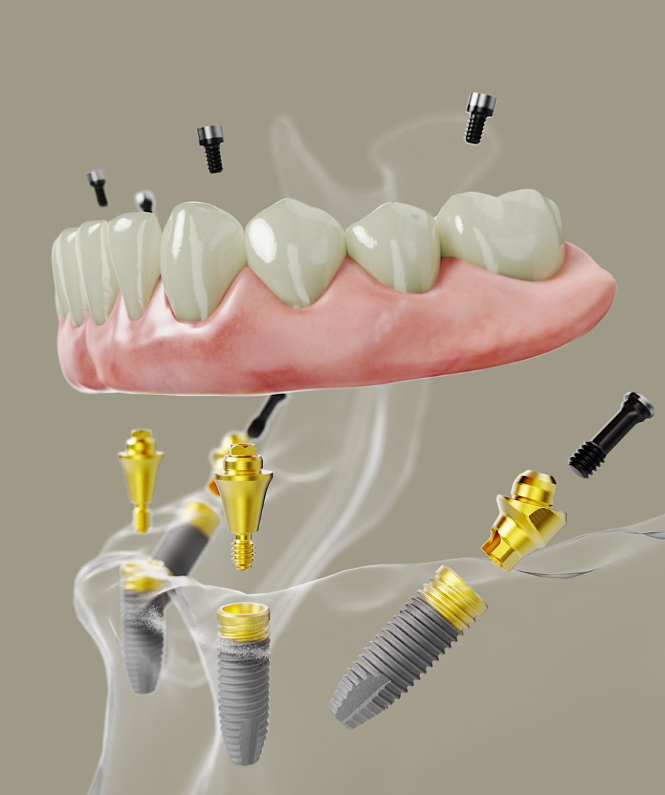 dental implant