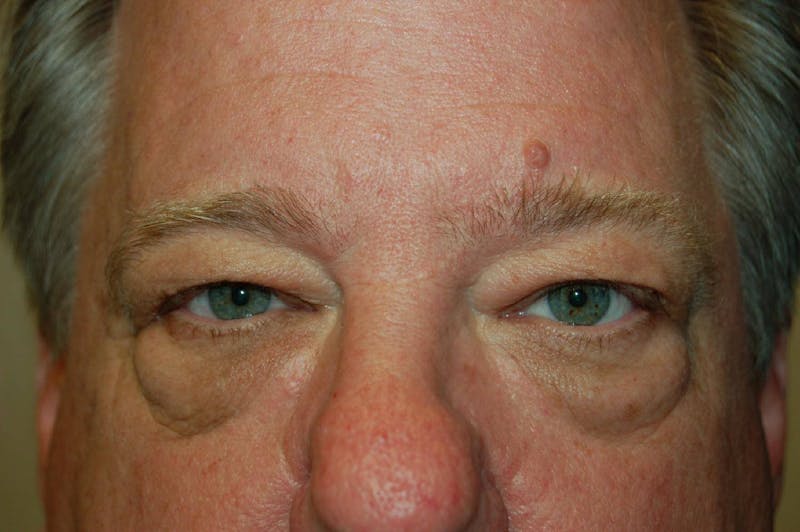 Blepharoplasty Before & After Gallery - Patient 36535133 - Image 1