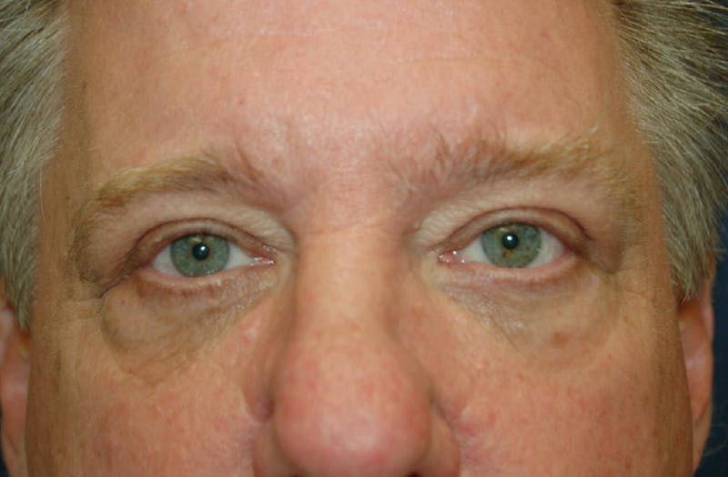Blepharoplasty Before & After Gallery - Patient 36535133 - Image 2